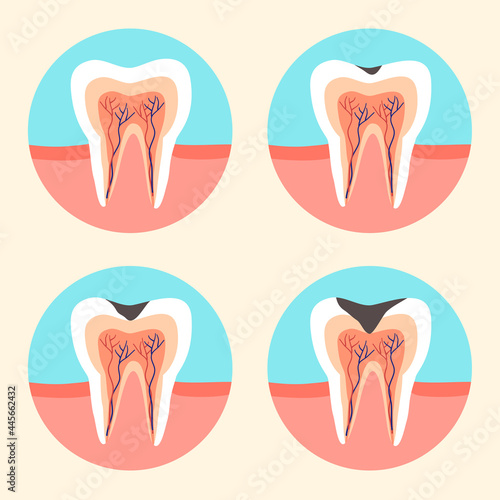 Stages of tooth caries in flat design. Tooth decay concept. Dental illness. 