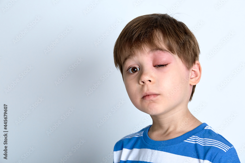 A boy with swollen eye from insect bite. Quincke edema. Portrait of Caucasian appearance child