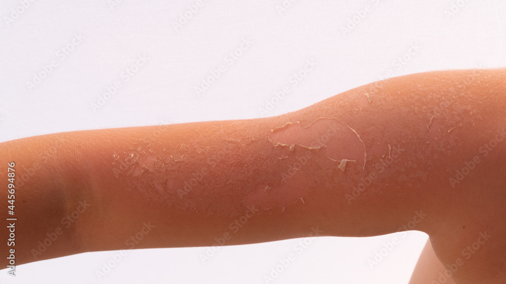 Fototapeta premium skin after sunburn. skin slips