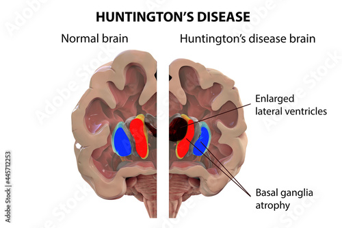 Coronal section of a brain of a person with Huntington's disease photo