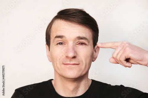 A middle-aged man on a light background suffers from an eye disease - conjunctivitis, his eye is very red and sore and the man can not work photo