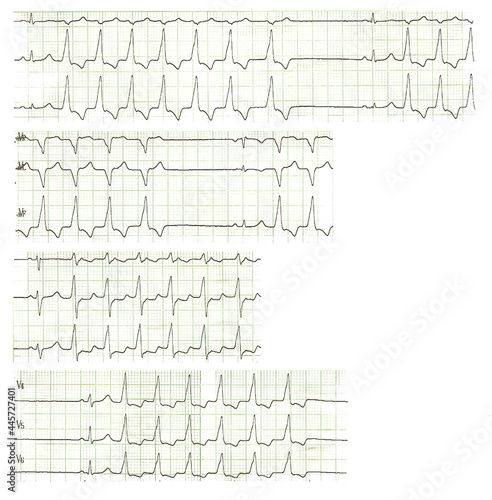фотографія Self-limited ventricular tachycardia