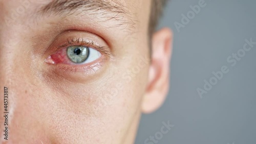 Close-up of the red eye of a man affected by an infection. photo