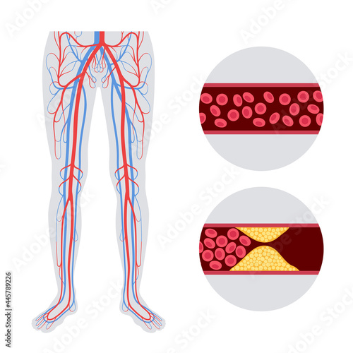 Peripheral artery disease