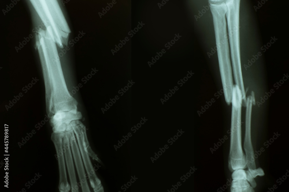 X-ray from broken foreleg (ulna and radius) of a dog. Front view (left ...