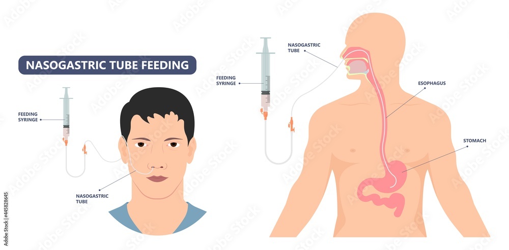 TPN PPN Total tube nutritional partial line PICC IV care unit ICU tract  enteral gavage nose PEG stomach surgery system small nose large food cancer  eat NG bowel PEJ pump Stock Vector
