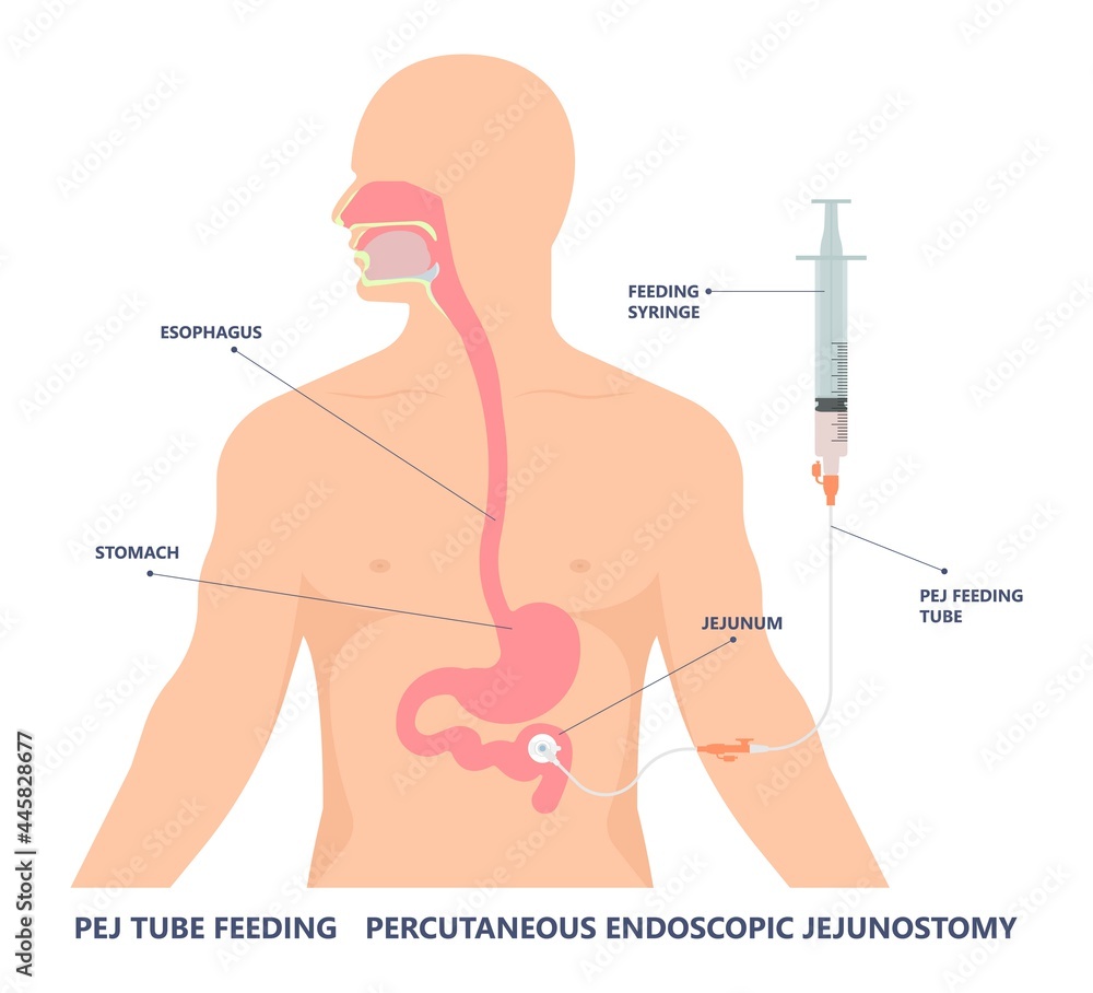 TPN PPN Total tube nutritional partial line PICC IV care unit ICU tract ...