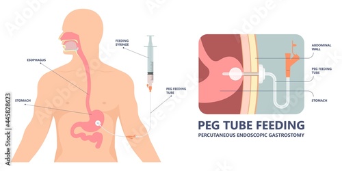 TPN PPN Total tube nutritional partial line PICC IV care unit ICU tract enteral gavage nose PEG stomach surgery system small nose large food cancer eat NG bowel PEJ pump