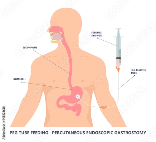 TPN PPN Total tube nutritional partial line PICC IV care unit ICU tract enteral gavage nose PEG stomach surgery system small nose large food cancer eat NG bowel PEJ pump