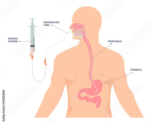 TPN PPN Total tube nutritional partial line PICC IV care unit ICU tract enteral gavage nose PEG stomach surgery system small nose large food cancer eat NG bowel PEJ pump photo