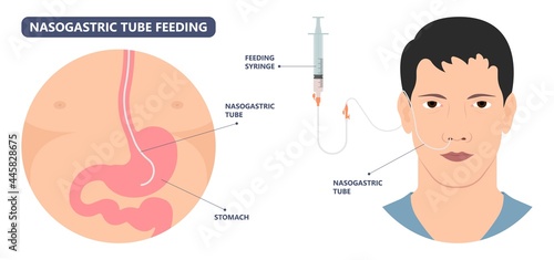TPN PPN Total tube nutritional partial line PICC IV care unit ICU tract enteral gavage nose PEG stomach surgery system small nose large food cancer eat NG bowel PEJ pump