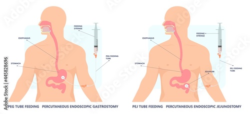 TPN PPN Total tube nutritional partial line PICC IV care unit ICU tract enteral gavage nose PEG stomach surgery system small nose large food cancer eat NG bowel PEJ pump