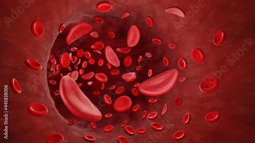 Sickle cells in bloodstream photo