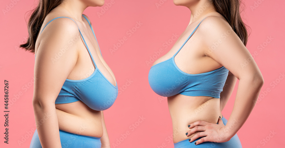 Before and after breast augmentation concept, woman with very large  silicone breasts after correction surgery Stock Photo