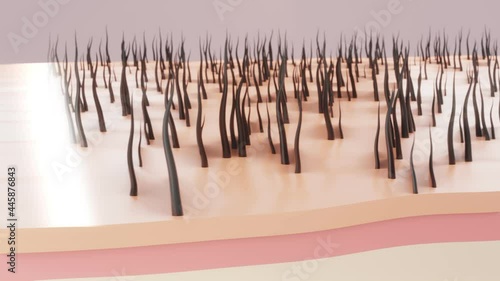 laser hair removal. 3d animation laser armpit treatment. laser light through the skin layer for hair removal. 