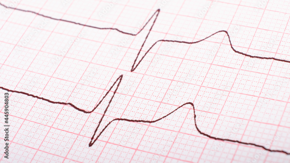cardiogram of heart impulses, hypertonic disease concept