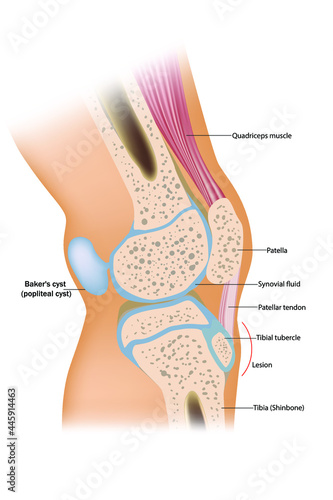 Baker's cyst (popliteal cyst). Anatomy of human knee Traumatology and orthopedics
