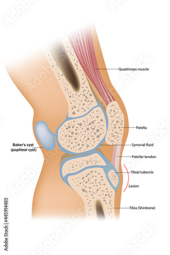 Baker cyst or popliteal cyst. Traumatology and orthopedics