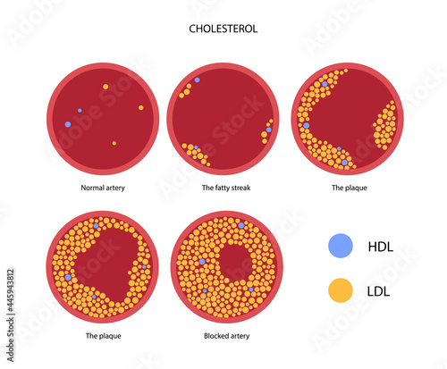 Cholesterol blood artery