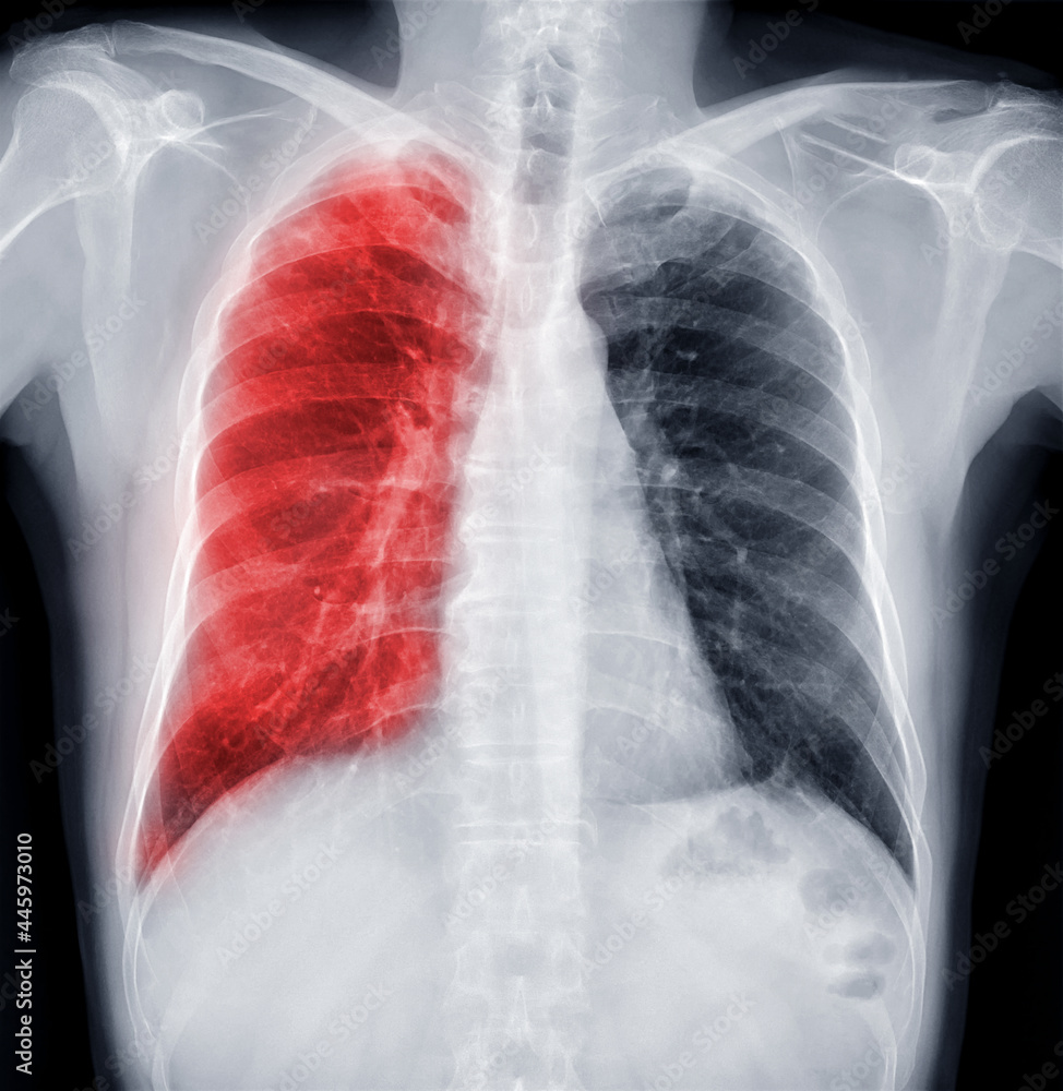 Chest X-ray Of Human Chest or Lung for detect tuberculosis Chest X-ray Of Human Chest or Lung for detect tuberculosis