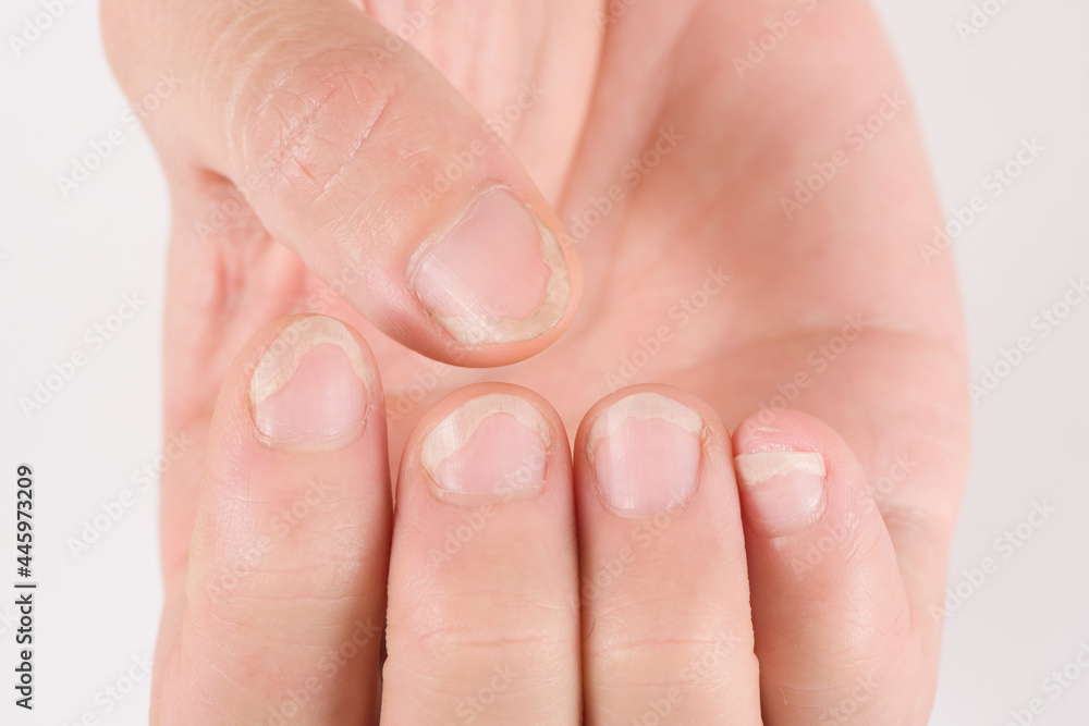 What Causes Fingernail Fungus? Symptoms and Treatment | ND Nails Supply