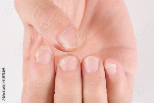 Onychomycosis or fungal nail infection on damaged nails after gel polish, onychosis. 