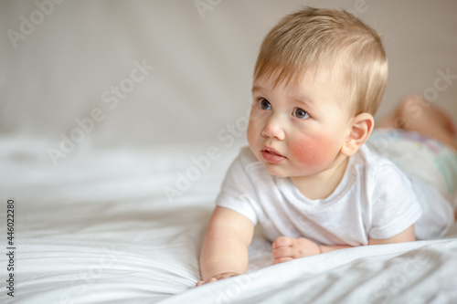 Atopic dermatitis eczema in baby.Condition that causes the skin to become red,dry,sore,itchy and cracked.Atopic eczema most often affects face in children. London England UK,Mart 30 2020