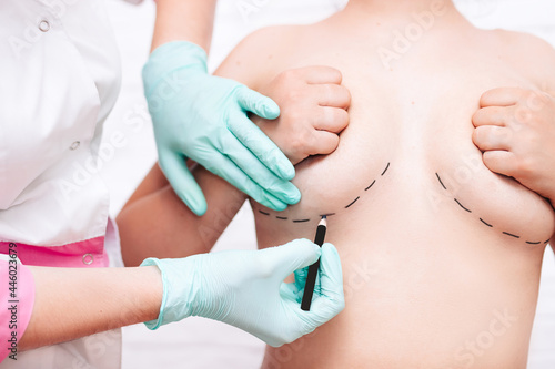 plastic breast correction. breast augmentation surgery.a plastic surgeon marks a woman's body for surgery to correct the figure
