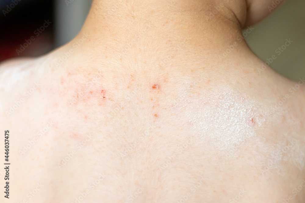 Red rush on child's back. Red spots on baby. Red skin on back. Atopic dermatitis of children's skin.The skin of an allergic child or hives is a rash. Red rush on child's back. Red spots on baby. Red skin on back. Atopic dermatitis of children's skin.The skin of an allergic child or hives is a rash.
