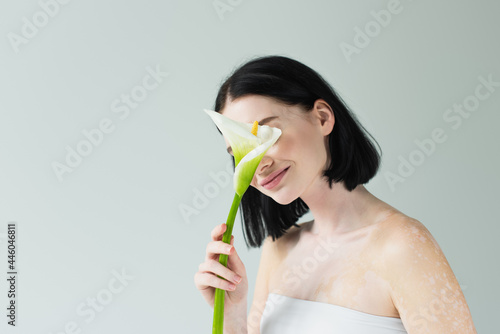 Woman with vitiligo covering face with calla lily isolated on grey