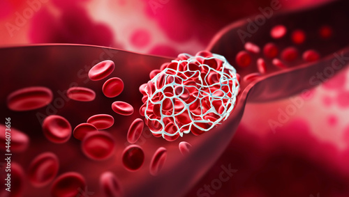 Blood clot blocking a blood vessel photo