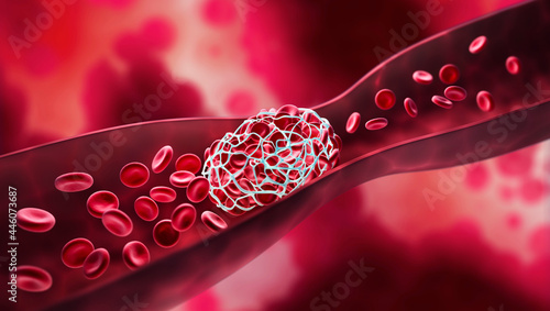 Blood clot blocking a blood vessel photo