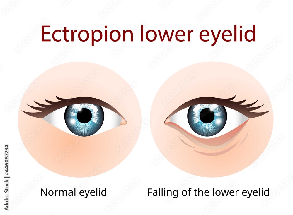 Ectropion Lower eyelid, Ectropion is a condition in which your eyelid turns outward - obrazy, fototapety, plakaty 