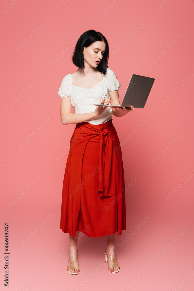 Fototapeta premium Stylish woman with vitiligo holding laptop on pink background
