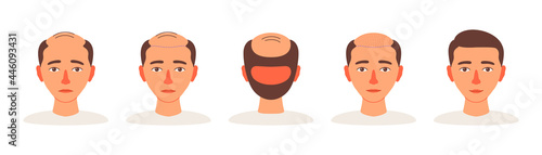 Stages of follicular unit extraction procedure for scalp hair transplantation, FUE. Treatment of hair loss in men, baldness, alopecia. Vector illustration medical infographics isolated
