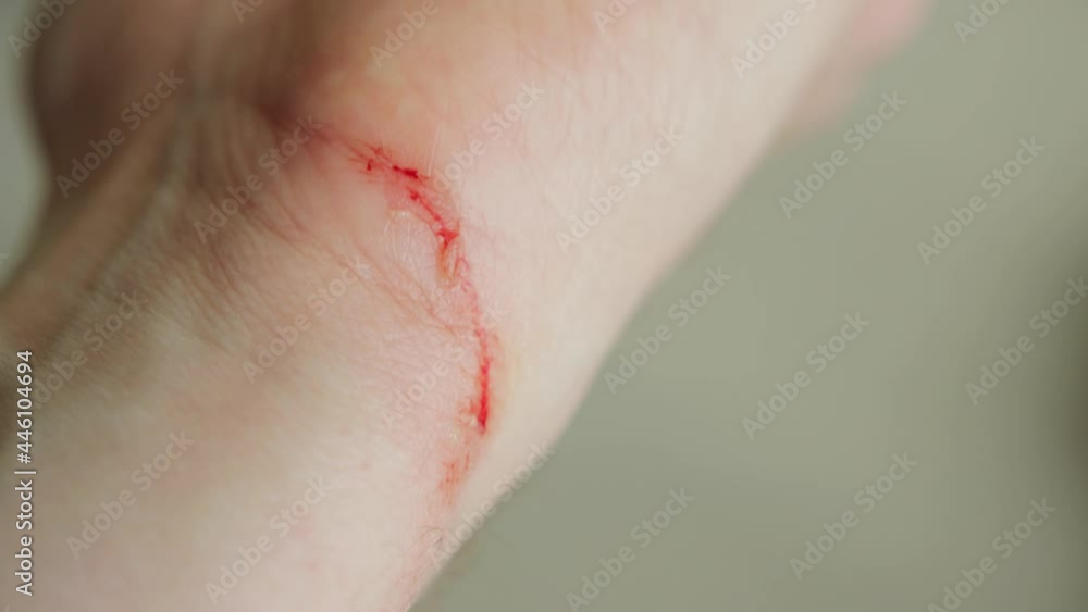 Wound cut on a man's hand, close-up. Blood on the wrist, skin Wound cut on a man's hand, close-up. Blood on the wrist, skin