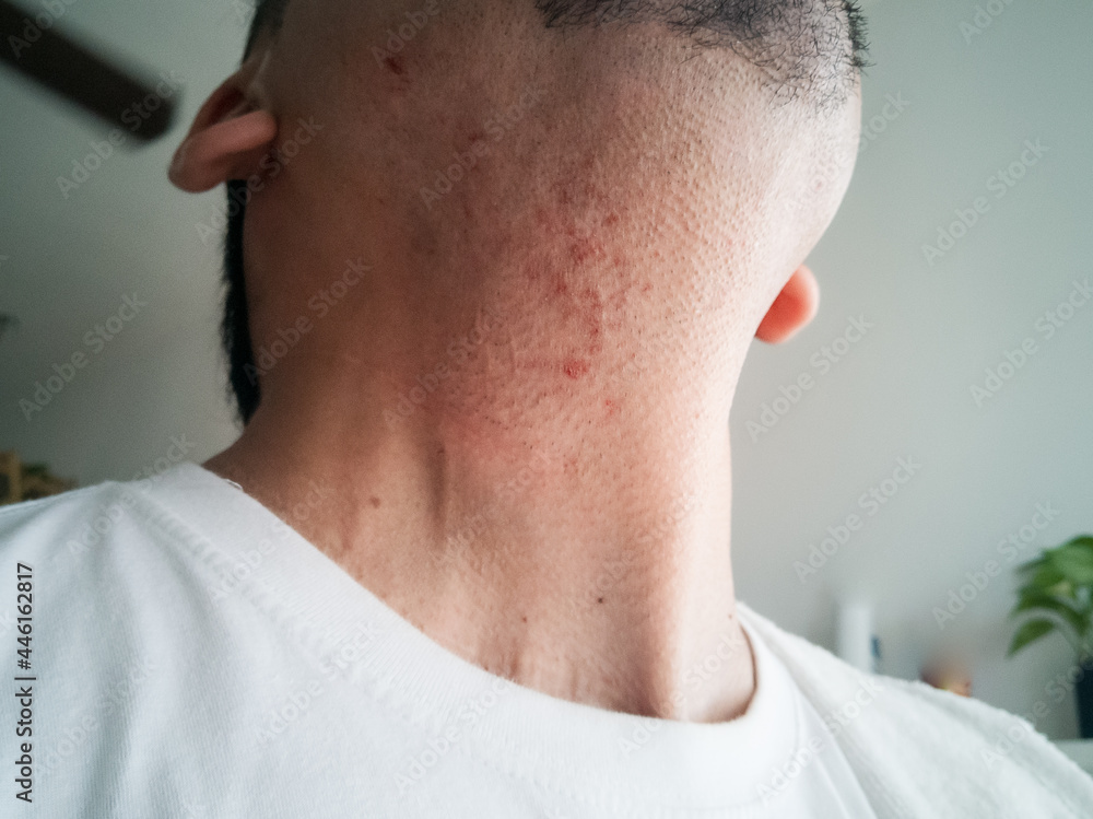 Obraz premium After shaving cut on the man's skin. Painful.