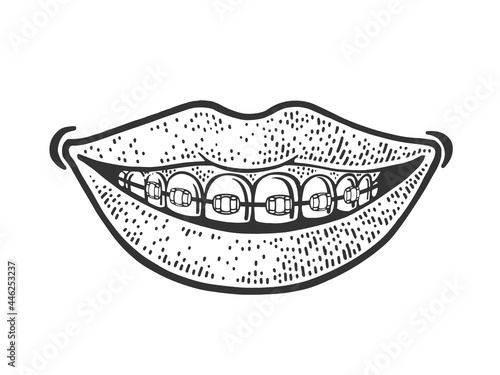 Dental braces smile line art sketch engraving vector illustration. T-shirt apparel print design. Scratch board imitation. Black and white hand drawn image.