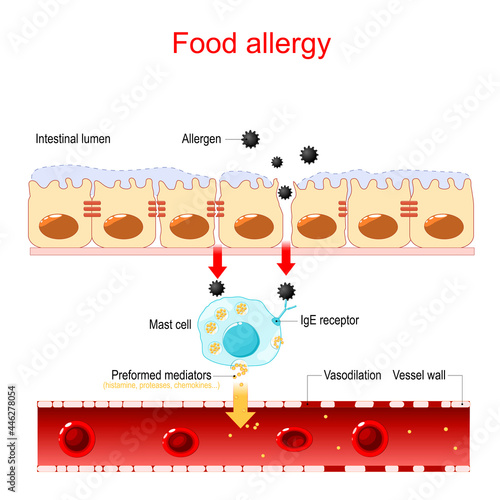 Food allergy and leaky gut