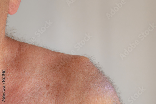 Human anatomy concept, Close up of a man with broken shoulder, The acromion is a bony process on the scapula (shoulder blade) Health care and medical. photo