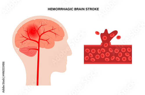 Brain stroke hemorrhagic