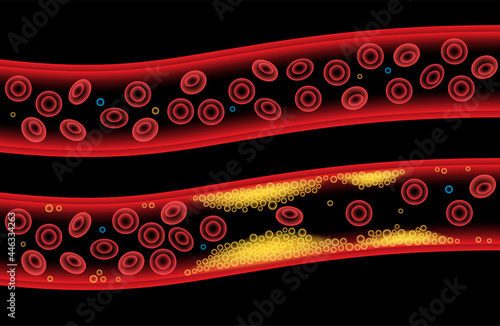 Cholesterol blood artery