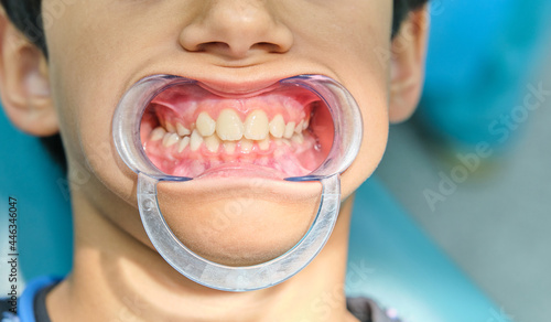 Tableau sur toile Caucasian boy with dental mouth opener