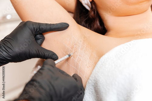 Cosmetologist in black latex gloves makes injection of botulinum toxin on the woman's axillary hollows against hyperhidrosis. Armpit with white drawn grid. Close up photo