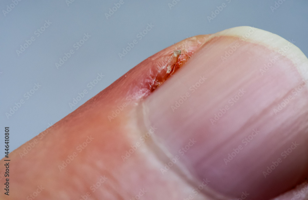 Inflamed cuticle on the finger. Damaged part of the finger, close-up. Inflamed cuticle on the finger. Damaged part of the finger, close-up.