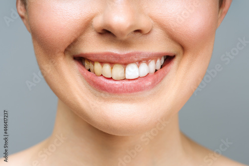 woman teeth before and after whitening. Over white background. Dental clinic patient. Image symbolizes oral care dentistry  stomatology.