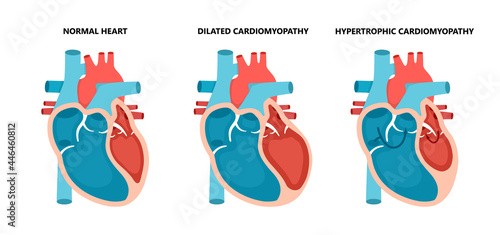 Types of heart diseases - normal, hypertrophic and dilated cardiomyopathy. Human heart muscle diseases cross-section. photo