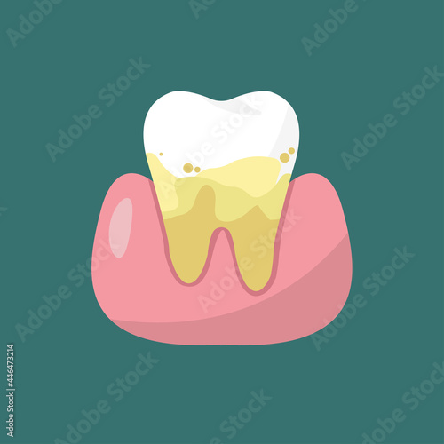 unhealthy teeth  dental and dentistry concept