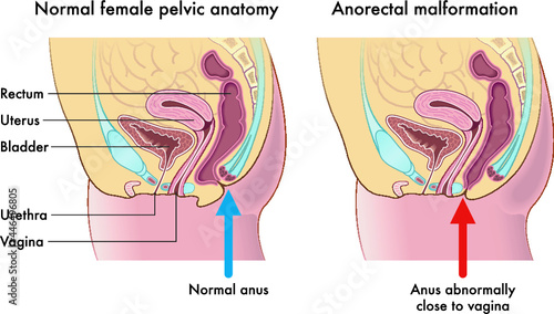 Medical illustration compares a normal female pelvic anatomy with one afflicted from anorectal malformation, with annotations