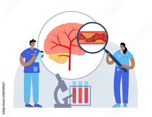 Brain stroke ishemic